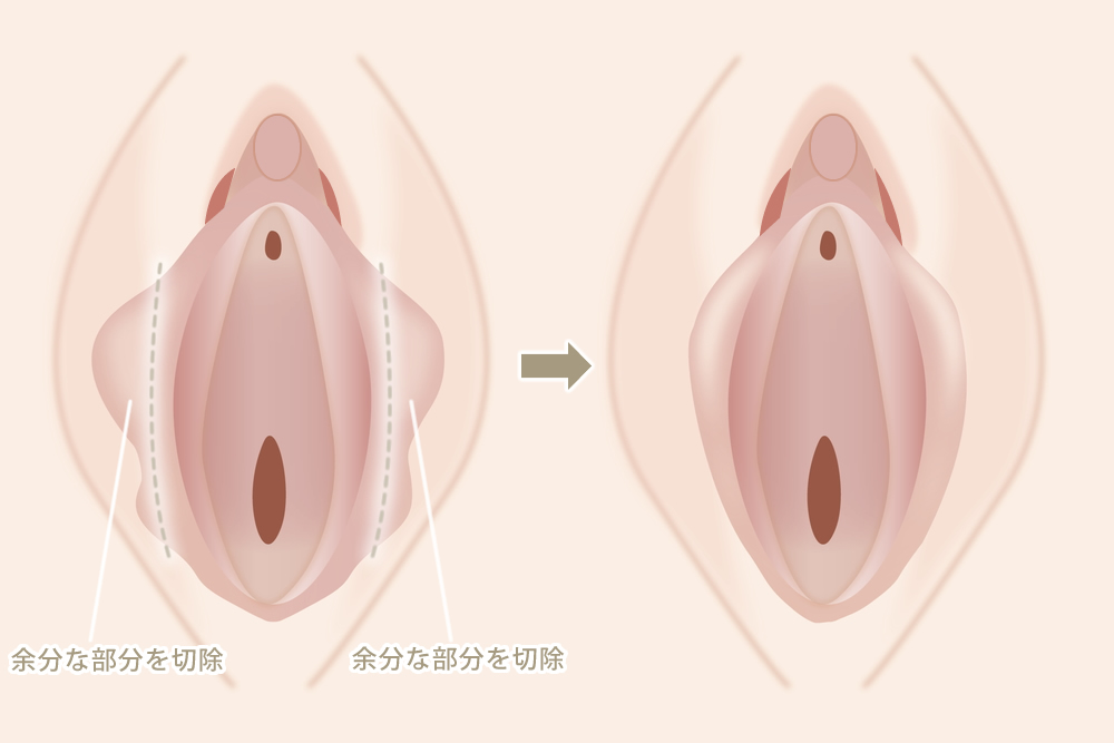 小陰唇縮小手術の図解