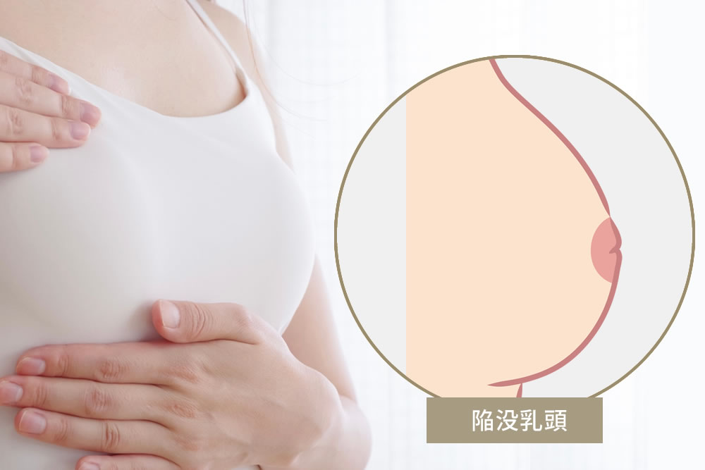 陥没乳頭